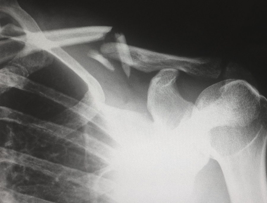 QUIZ | How Much Do You Know About Osteoporosis | HealthDiscovery.org