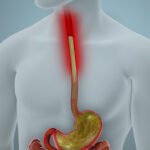 Acid Reflux GERD Disease Illustration | Corporate Synergies