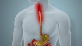 Acid Reflux GERD Disease Illustration | Corporate Synergies